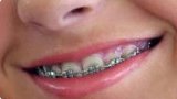 Phase 2 Orthodontics - Fixed Braces