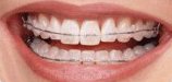Phase 1 Orthodontics